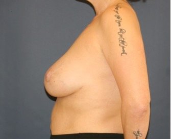Breast Augmentation Lift 66 - after - side