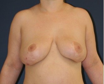 Breast Augmentation Lift 67 - before - front
