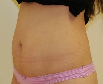 Tummy Tuck Case 9 - before - Left Oblique