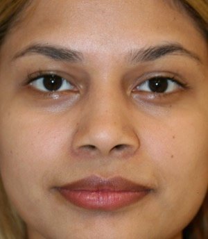 Rhinoplasty Nostril Narrowing - before - front