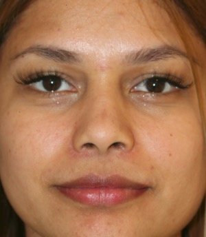 Rhinoplasty Nostril Narrowing - after - front