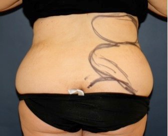 Liposuction Back-Flanks 213 - before - front