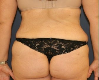 Liposuction Back-Flanks 213 - after - front