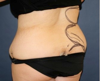 Liposuction Back-Flanks 213 - before - oblique