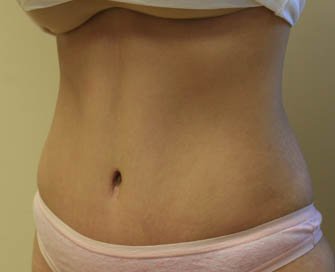 Tummy Tuck Case 9 - after - Left Oblique