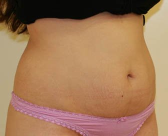 Tummy Tuck Case 9 - before - Right Oblique