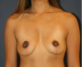 Breast Lift 309 - after - front