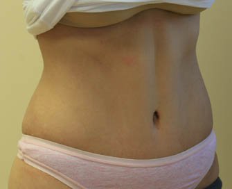 Tummy Tuck Case 9 - after - Right Oblique