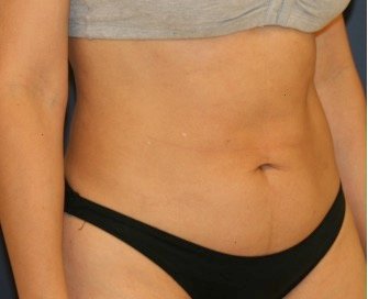 Liposuction Flanks 215 - before - front