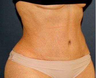 Liposuction Flanks 215 - after - front