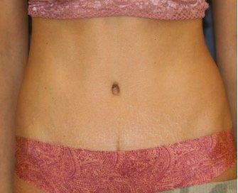 Tummy Tuck 245 - after - front