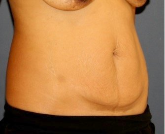 Tummy Tuck 245 - before - oblique