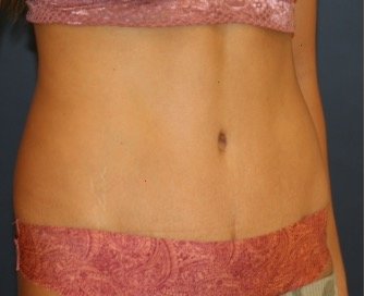 Tummy Tuck 245 - after - oblique