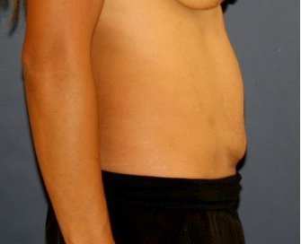 Tummy Tuck 245 - before - side