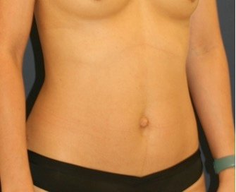 Tummy Tuck 246 - before - oblique