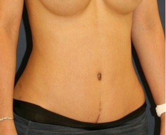 Tummy Tuck 246 - after - oblique