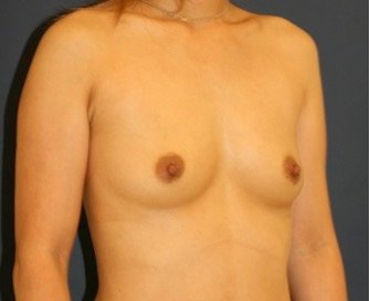 Breast Augmentation 159 - before - oblique