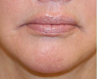 Corner Lip Lift 212 - before - front