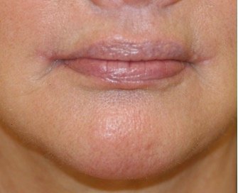 Corner Lip Lift 212 - after - front