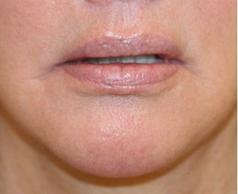 Corner Lip Lift 212 - before - oblique