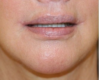 Corner Lip Lift 212 - after - oblique