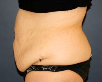 Tummy Tuck 247 - before - front
