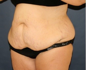 Tummy Tuck 247 - before - oblique