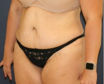 Tummy Tuck 247 - after - oblique