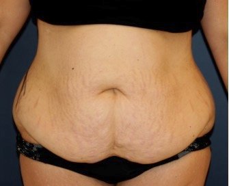 Tummy Tuck 247 - before - side