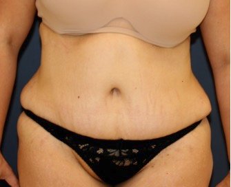 Tummy Tuck 247 - after - side