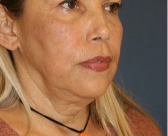 Necklift 206 - before - oblique