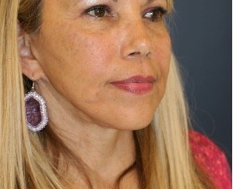 Necklift 206 - after - oblique