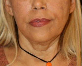 Necklift 206 - before - side