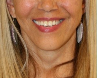 Necklift 206 - after - side