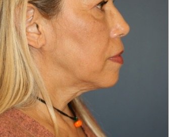 Necklift 206 - before - front