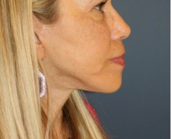 Necklift 206 - after - front