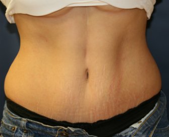 Tummy Tuck Case 16 - after - front