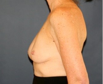 Deflated Left Implant Replacement 412 - before - front