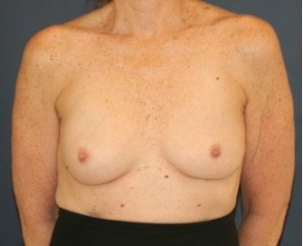 Deflated Left Implant Replacement 412 - before - side