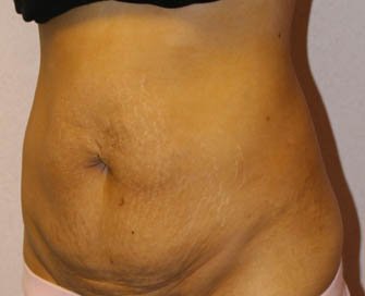 Tummy Tuck Case 16 - before - Left Oblique