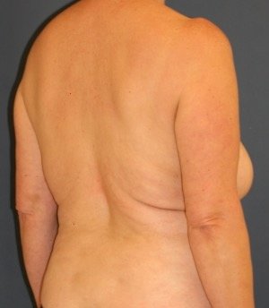 Liposuction Back 216 - before - oblique