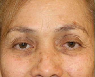Blepharoplasty 110 - before - front