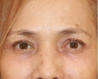 Blepharoplasty 110 - after - front