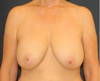 Breast Implant Removal 203 - before - side