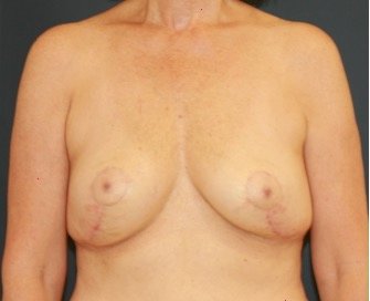 Breast Implant Removal 203 - after - side