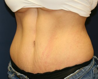 Tummy Tuck Case 16 - after - Left Oblique