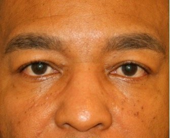 Blepharoplasty 111 - before - front