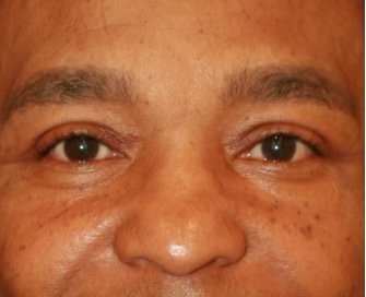 Blepharoplasty 111 - after - front