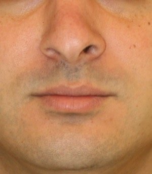 Rhinoplasty 215 - before - side