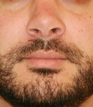 Rhinoplasty 215 - after - side